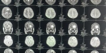 بلخ حوزوی کسلخانه‌سیده ایلک‌بار مییه توموری عملیاتی عملگه آشیریلدی