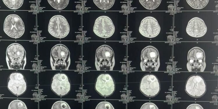 بلخ حوزوی کسلخانه‌سیده ایلک‌بار مییه توموری عملیاتی عملگه آشیریلدی